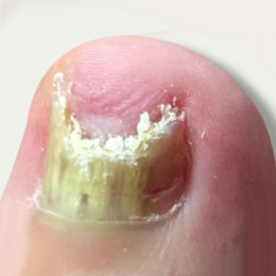 Treatment for fungal nails in Madurai