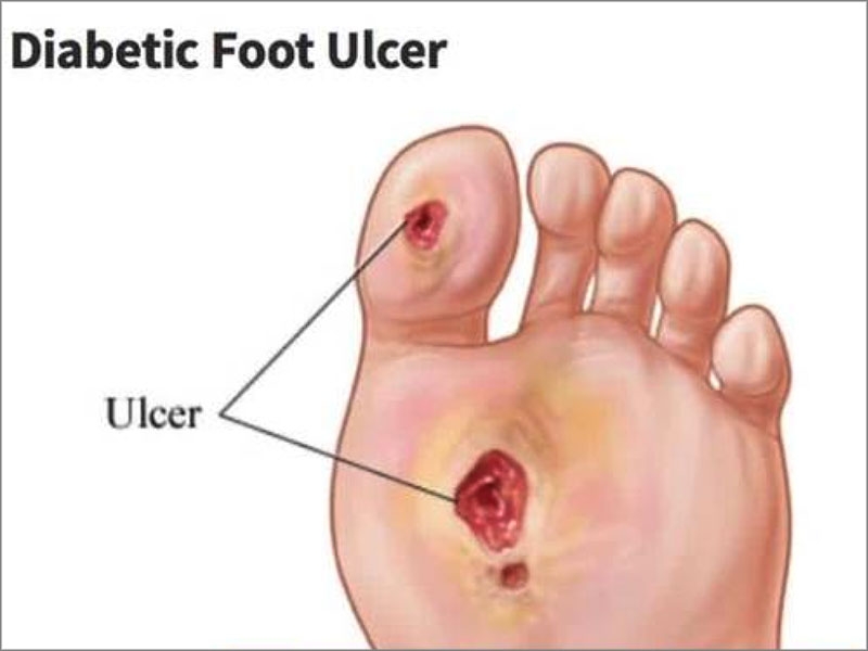 diabetic foot ulcer treatment in tamil nadu