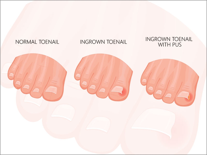 Ingrown Toenail Treatment | Amputation prevention clinic Madurai/Tamil Nadu  | Madurai Foot Care
